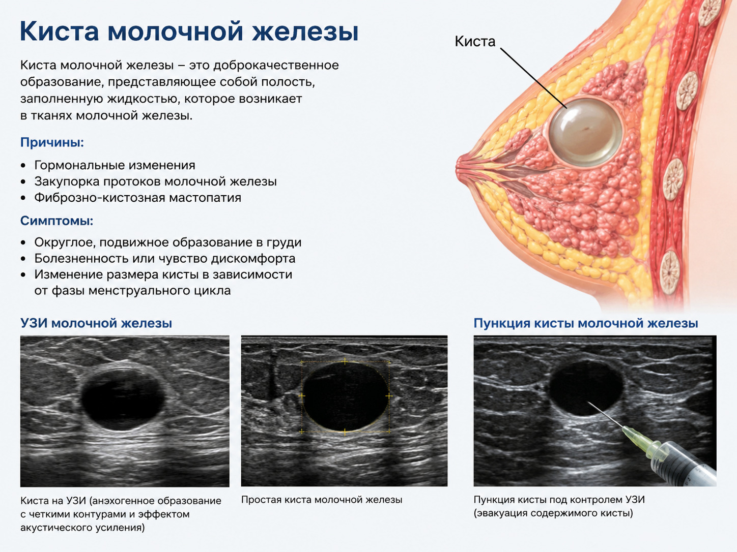 Киста молочной железы: симптомы, признаки, виды и лечение у женщин