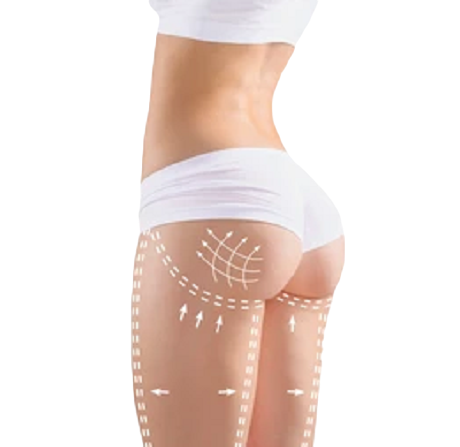 Липофилинг