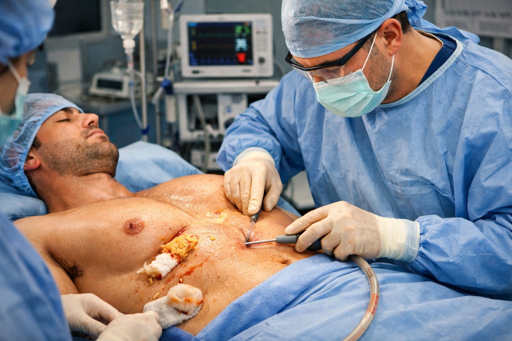 Ложная гинекомастия: особенности заболевания и методы коррекции Ложная гинекомастия: особенности заболевания и методы коррекции