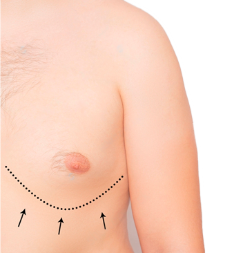 Лечение гинекомастии Лечение гинекомастии