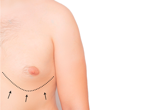 Лечение гинекомастии