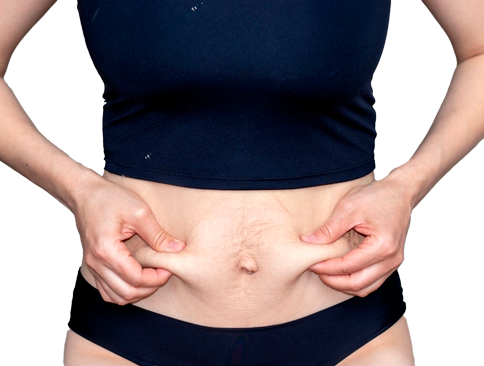 Диастаз без шрамов Диастаз без шрамов